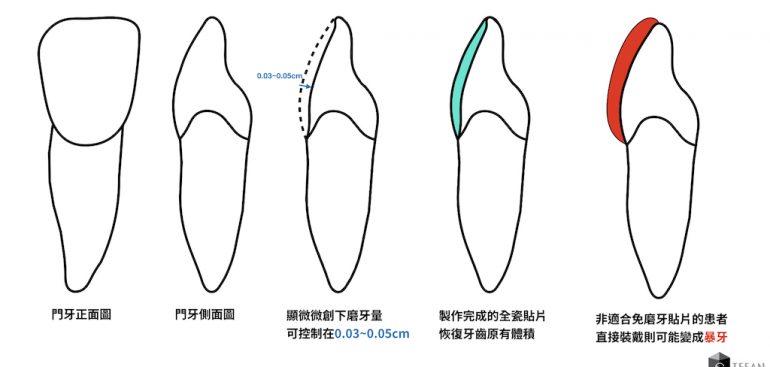 瓷牙貼片後遺症有哪些 超後悔做免磨牙瓷牙貼片 為什麼 專家告訴你