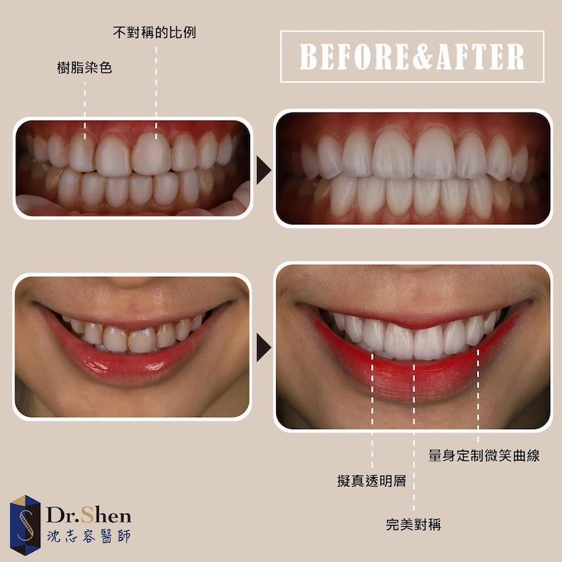 心得 台北張紫陽醫師 陶瓷貼片 美白與修牙齦 看板teeth Salon Ptt網頁版